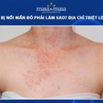 triệt lông bị nổi mẩn đỏ