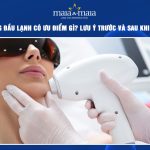 Triệt lông đầu lạnh