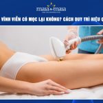 triệt lông vĩnh viễn có mọc lại không