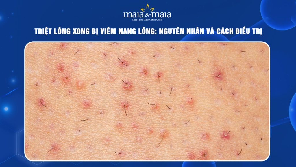 Triệt lông xong bị viêm nang lông: Nguyên nhân và cách điều trị  1 triệt lông xong bị viêm nang lông
