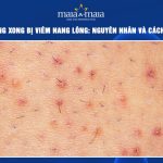 triệt lông xong bị viêm nang lông