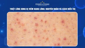 Triệt lông xong bị viêm nang lông: Nguyên nhân và cách điều trị  45 triệt lông xong bị viêm nang lông