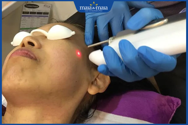 bắn laser trị nám