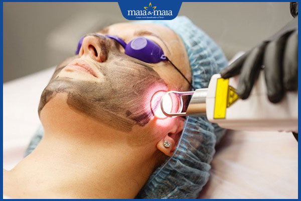 bắn laser xóa nam