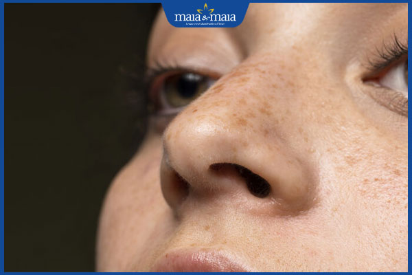 bị nám khi còn trẻ tuổi