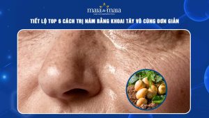 Tiết lộ top 6 cách trị nám bằng khoai tây vô cùng đơn giản 72 cách trị nám bằng khoai tây