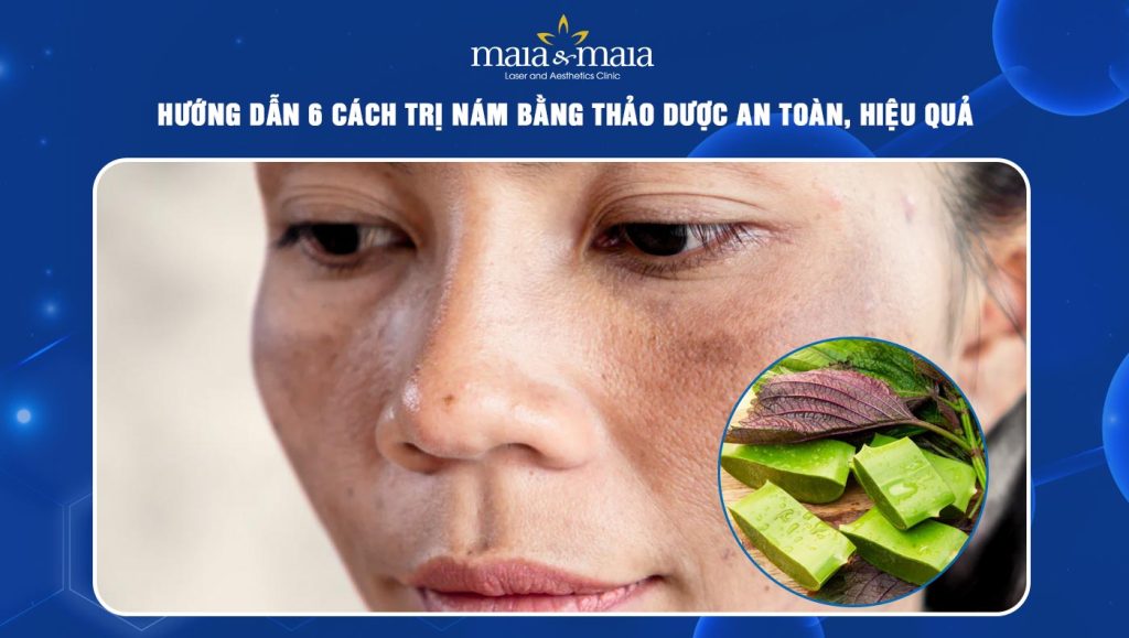 cách trị nám bằng thảo dược
