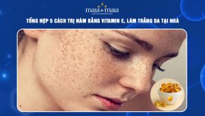 Tổng hợp 5 cách trị nám bằng vitamin E, làm trắng da tại nhà 93 cách trị nám bằng vitamin e