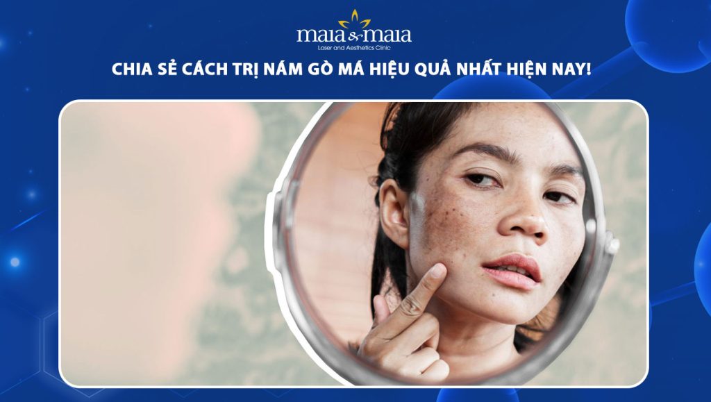 Tổng hợp các cách trị nám gò má đơn giản, dưỡng trắng tại nhà 1 cách trị nám gò má