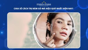 Tổng hợp các cách trị nám gò má đơn giản, dưỡng trắng tại nhà 47 cách trị nám gò má
