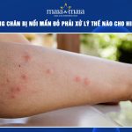 cạo lông chân bị nổi mẩn đỏ