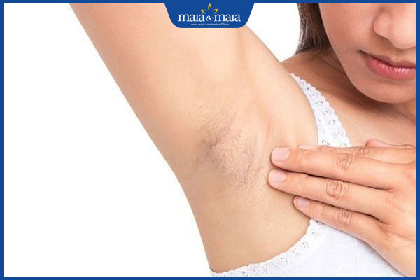 cạo lông nách bị thâm