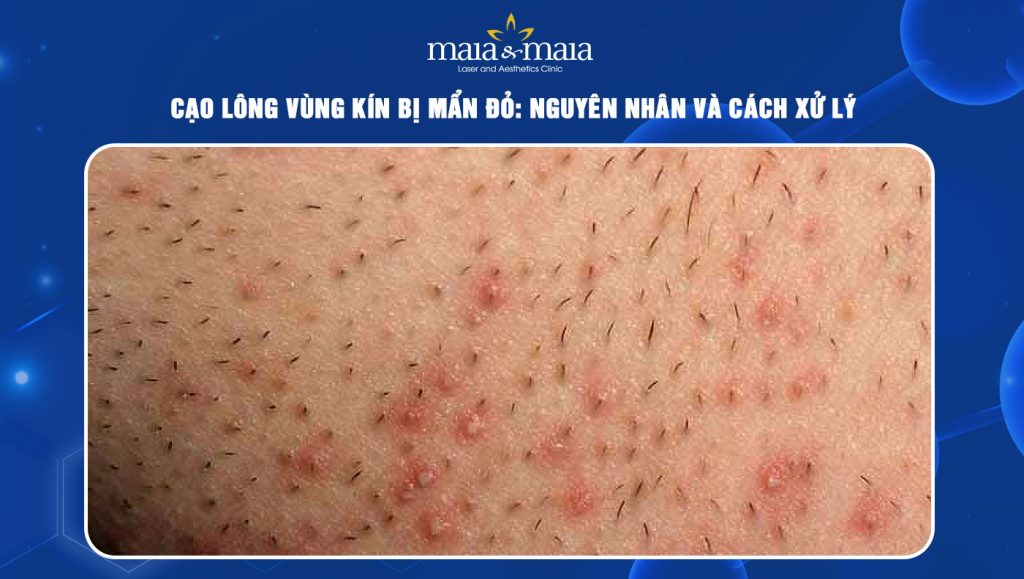 Cạo lông vùng kín bị mẩn đỏ