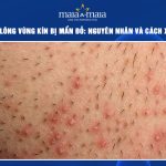 Cạo lông vùng kín bị mẩn đỏ