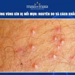 cạo lông vùng kín bị nổi mụn