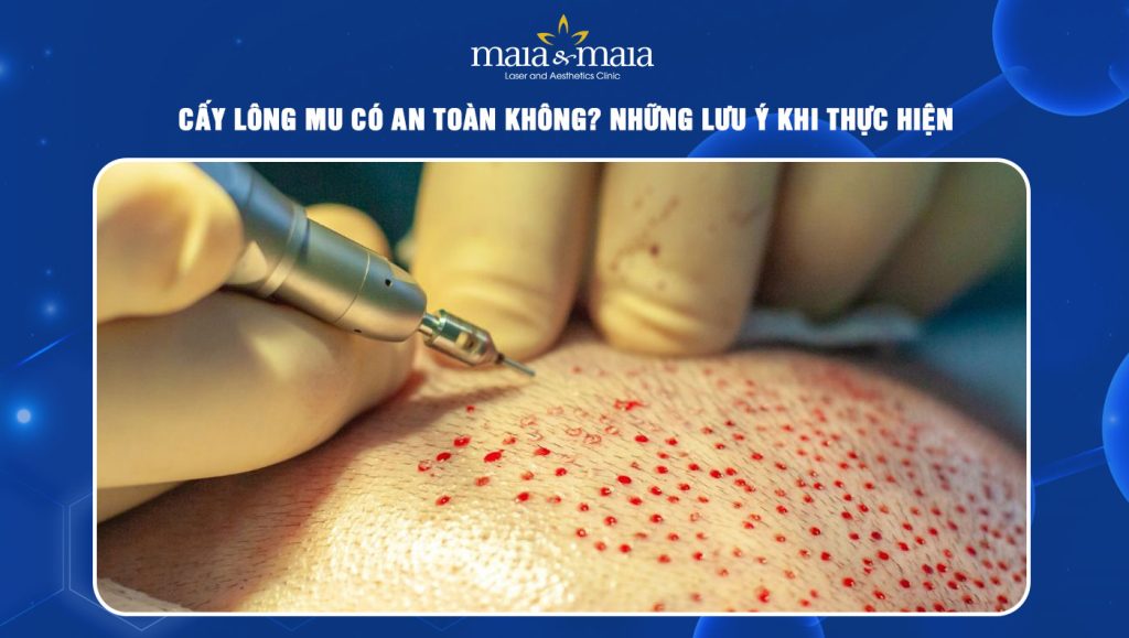 Cấy lông mu