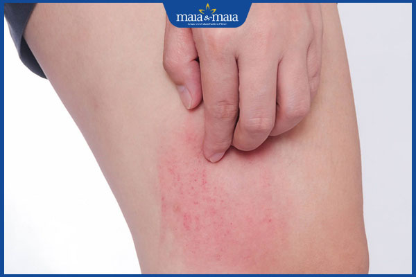 Thế nào là tẩy lông chân bằng dầu oliu? Hiệu quả ra sao? 3 chân bị viêm đỏ