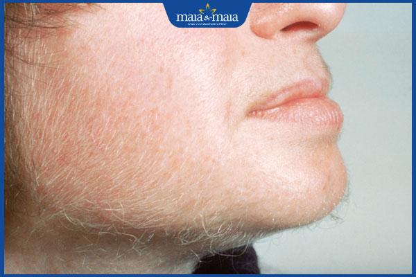 Có nên triệt lông mặt không? Công nghệ triệt lông an toàn 2 công dụng lông mặt