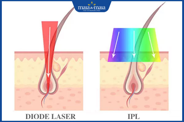 công nghệ diode laser và ipl