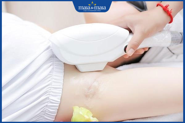 Bật mí cách triệt lông nách ở tuổi dậy thì hiệu quả, an toàn 5 công nghệ ipl