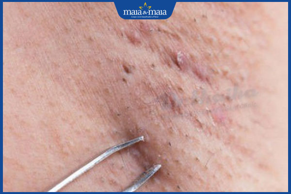 da bị tổn thương