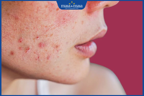 Bật mí các cách trị nám bằng quả cam an toàn với da nhạy cảm 4 da nám mẩn đỏ