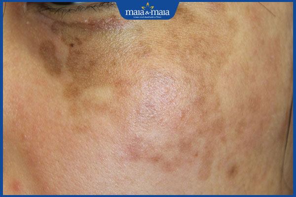 Thế nào là nám chân sâu? Có điều trị dứt điểm được không? 2 dấu hiệu nám chân sâu