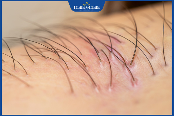 dấu hiệu nang lông bị viêm