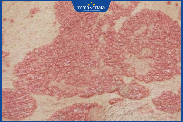 dị ứng da do dùng thuốc mọc lông mu