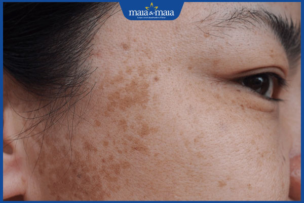 điều trị nám hỗn hợp