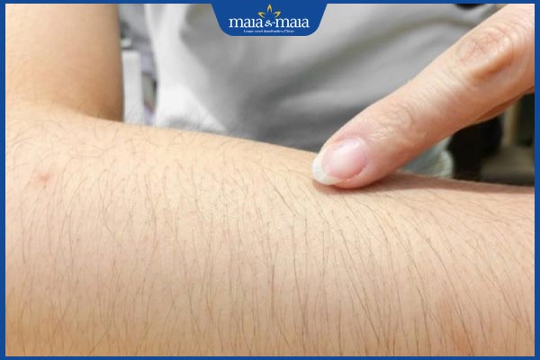 đối tượng triệt lông opt shr