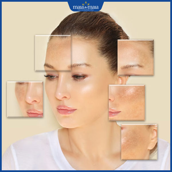 đốm nám trên da