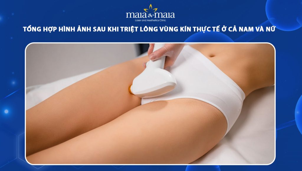hình ảnh sau khi triệt lông vùng kín
