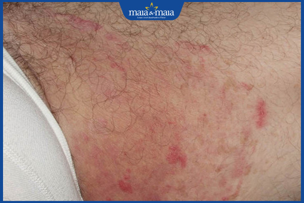 Sau khi cạo lông vùng kín nên bôi gì? Lưu ý chăm sóc vùng kín sau cạo 2 kích ứng sau cạo lông vùng kín