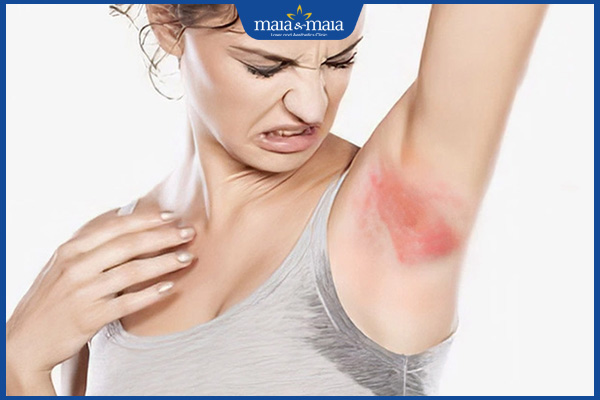 kích ứng sau khi triệt lông nách ở nữ