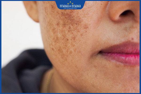 loại nám hỗn hợp