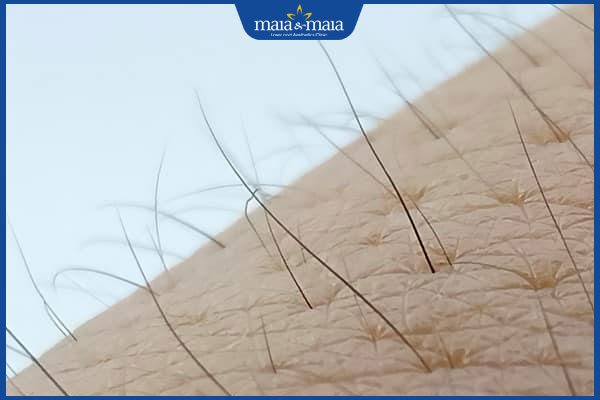 lựa chọn công nghệ triệt lông