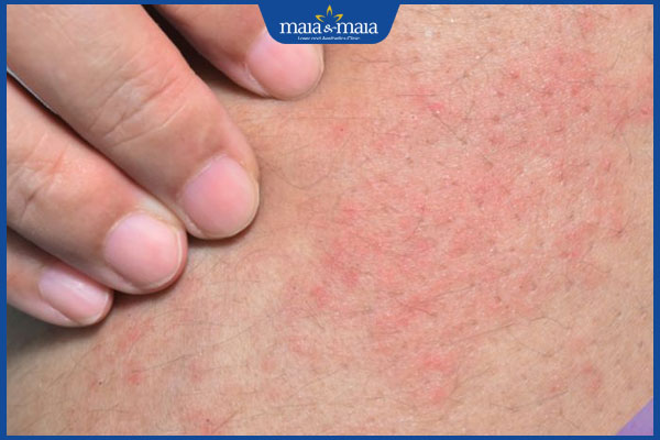 mẩn đỏ và ngứa ngáy sau triệt lông vùng kín