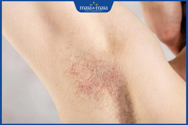 Wax lông nách mang lại lợi ích gì? Quy trình như thế nào? 4 nách bị kích ứng