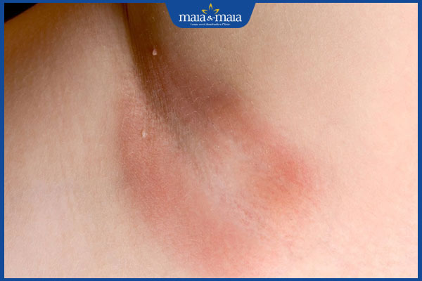 Tác hại cạo lông nách ở tuổi dậy thì và giải pháp thay thế 2 nách bị mẩn đỏ