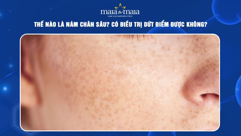 Thế nào là nám chân sâu? Có điều trị dứt điểm được không? 1 nám chân sâu