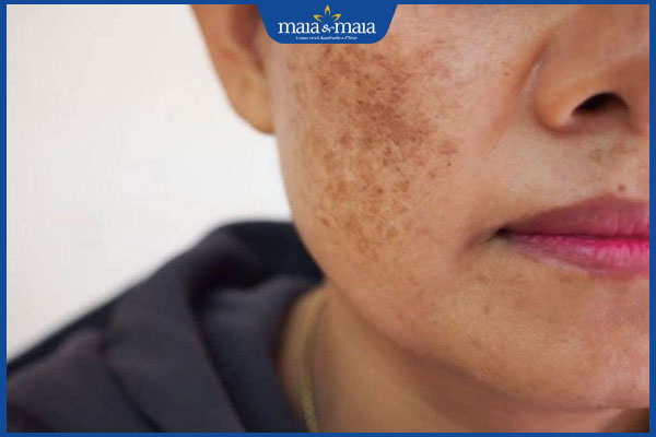 Trị nám bằng nhân sâm có hiệu quả không? Gợi ý cách thực hiện 6 nám da nặng