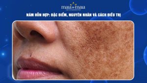 Nám hỗn hợp: Đặc điểm, nguyên nhân và cách điều trị 47 nám hỗn hợp