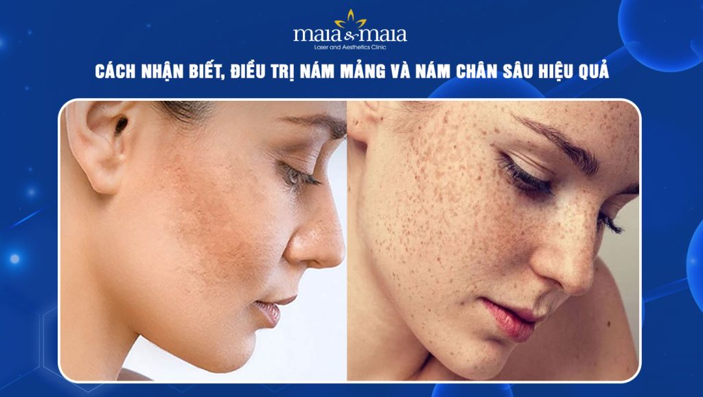 Cách nhận biết, điều trị nám mảng và nám chân sâu hiệu quả 1 nám mảng và nám chân sâu