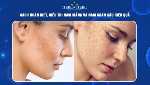 Cách nhận biết, điều trị nám mảng và nám chân sâu hiệu quả 36 nám mảng và nám chân sâu