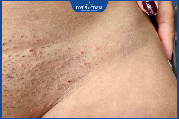 Triệt lông bikini bị nổi mụn phải làm sao? Địa chỉ triệt lông an toàn 2 nguyên nhân triệt lông bikini nổi mụn