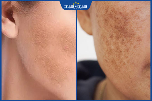 Cách nhận biết, điều trị nám mảng và nám chân sâu hiệu quả 2 nhận biết nám mảng và nám chân sâu