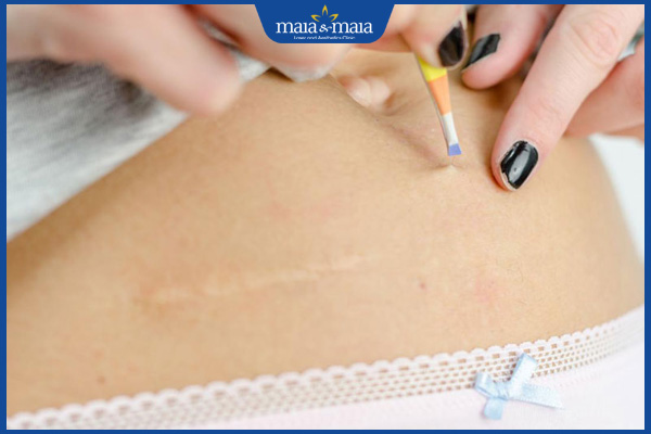 Tác hại khi nhổ lông vùng kín và giải pháp "dọn cỏ" an toàn 2 nhổ lông vùng kín bằng nhíp