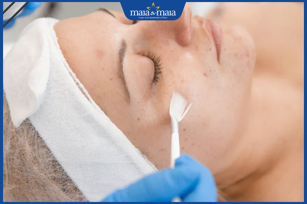 Thế nào là nám chân sâu? Có điều trị dứt điểm được không? 3 peel da nám