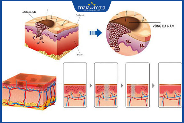 quy trình trị nám